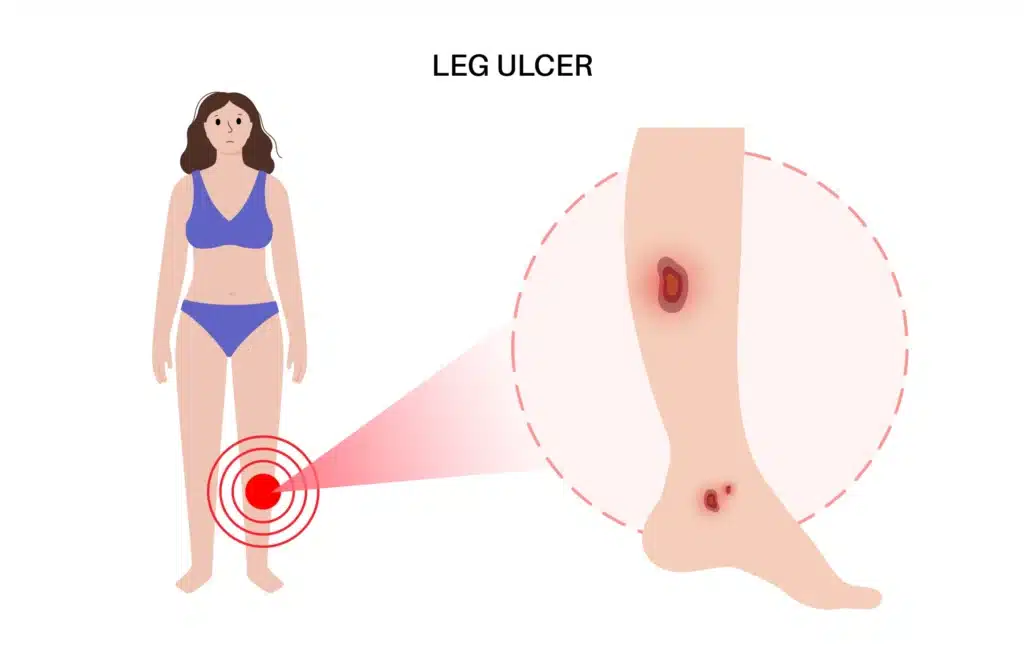 Espada Vascular in Texas treats Leg Ulcers in San Antonio and beyond with minimally invasive procedures.